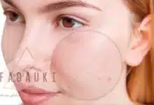 علاج المسامات الواسعة في الوجه