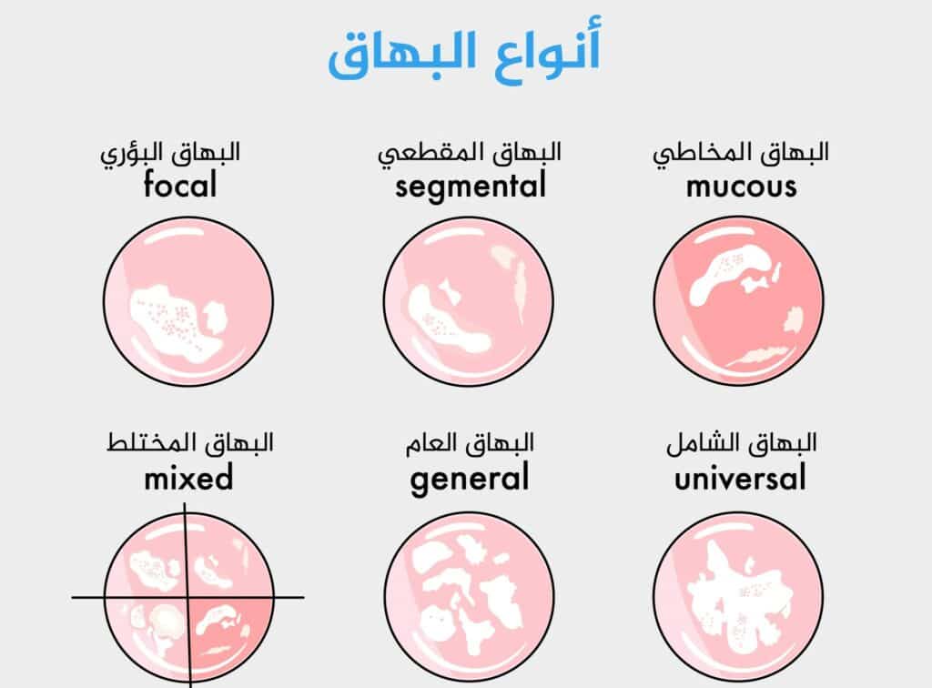 بداية البهاق بالصور