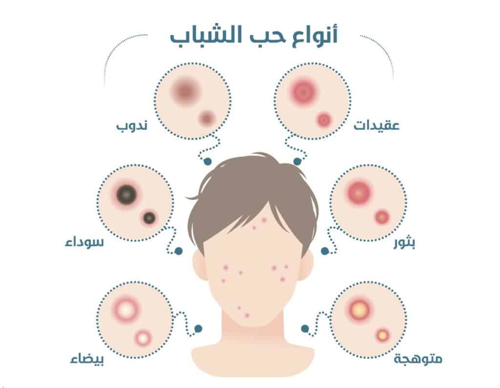 افضل مرهم لعلاج حبوب الظهر والصدر